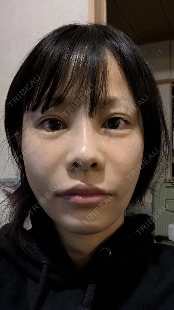 糸リフト / 脂肪吸引（顔） / その他（輪郭） / ジョールファット除去 WOM CLINIC GINZA （ワム クリニック ギンザ） DAY 14 メイン用