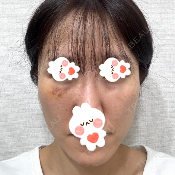 肌ヒアルロン酸注入（たるみ・シワ改善） しのぶ皮膚科 DAY 9 メイン用