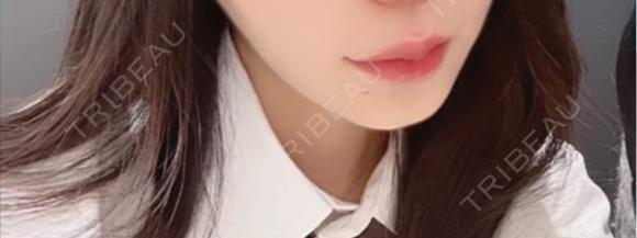 ヒアルロン酸注入（唇） 目白ホワイトクリニック AFTER メイン用