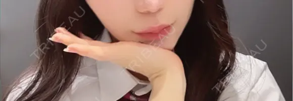 ボトックス（眉間） mimi CLINIC AFTER メイン用