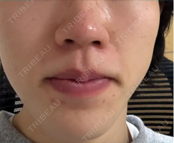 イオン導入 Kinshicho Beauty Clinic （錦糸町ビューティークリニック） DAY 8 メイン用