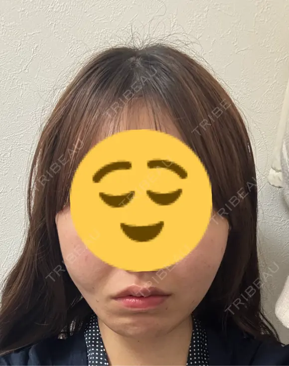 糸リフト 形成外科と美容外科のクリニック池袋 DAY 0 メイン用