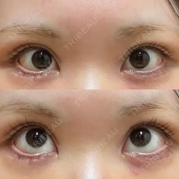 タレ目形成・グラマラスライン（切開） 形成外科と美容外科のクリニック池袋 DAY 9 メイン用