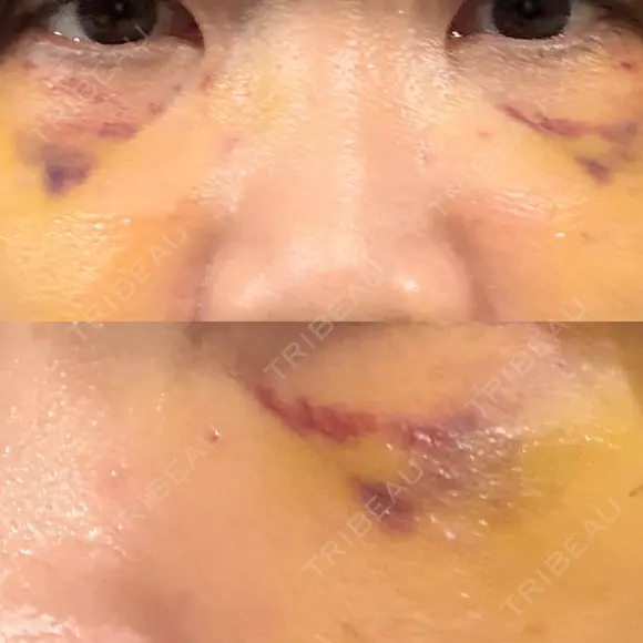 クマ治療 池袋麗歯科・美容皮膚科 DAY 10 メイン用