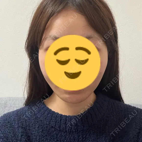 糸リフト 形成外科と美容外科のクリニック池袋 AFTER メイン用