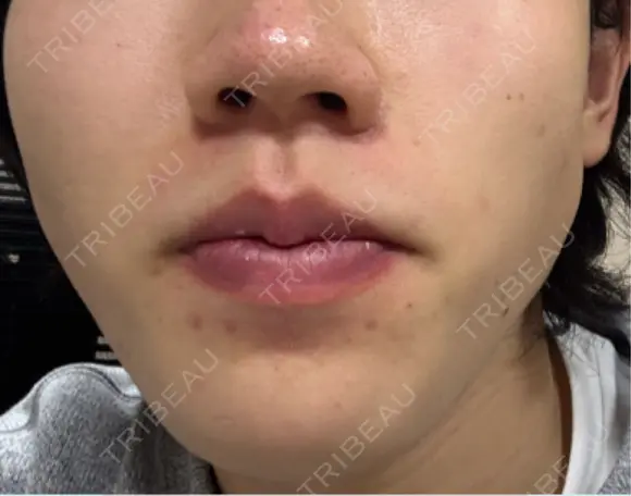 イオン導入 Kinshicho Beauty Clinic （錦糸町ビューティークリニック） DAY 9 メイン用