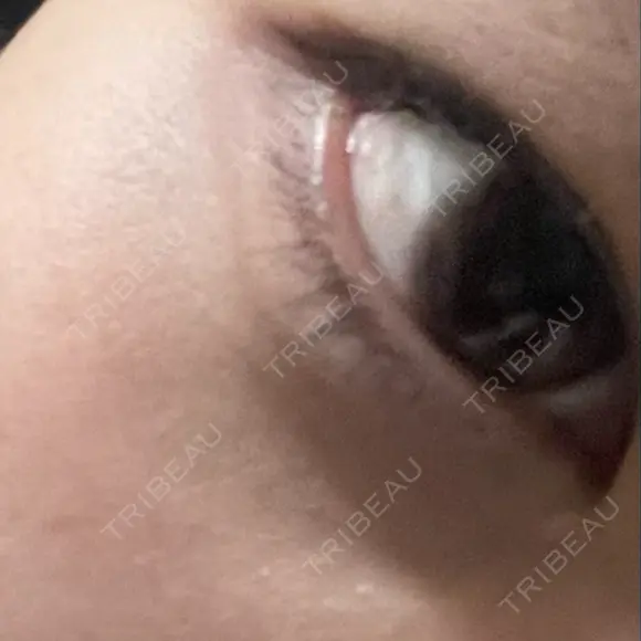 クマ治療 PureMe Skin Clinic（ピュアミースキンクリニック麻布） DAY 226 メイン用