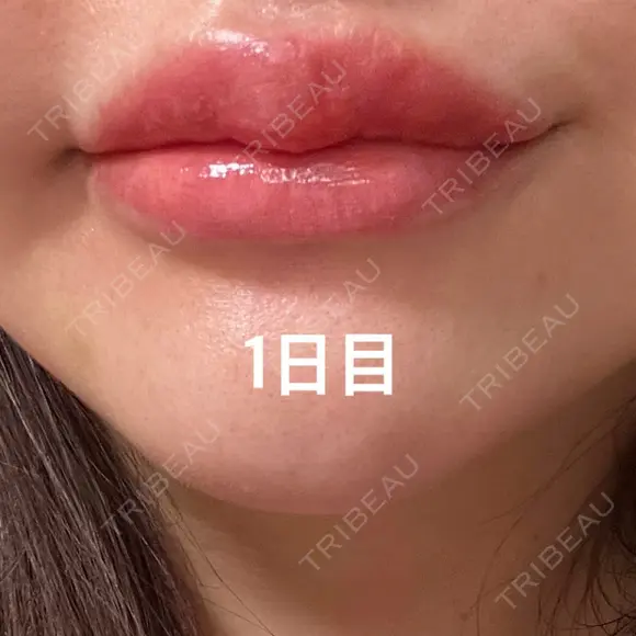 アートメイク（唇） / アートメイク（アイライン） Kinshicho Beauty Clinic （錦糸町ビューティークリニック） DAY 2 メイン用