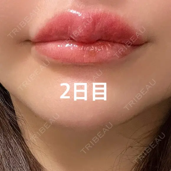 アートメイク（唇） / アートメイク（アイライン） Kinshicho Beauty Clinic （錦糸町ビューティークリニック） DAY 2 メイン用
