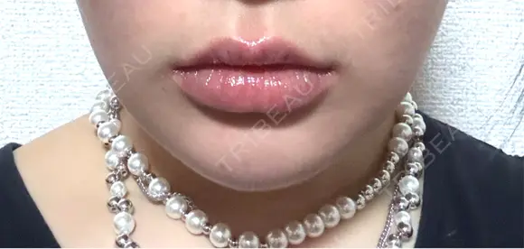 その他（輪郭） Clinic K Blossom DAY 6 メイン用