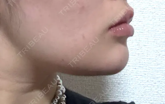 その他（輪郭） Clinic K Blossom DAY 6 メイン用