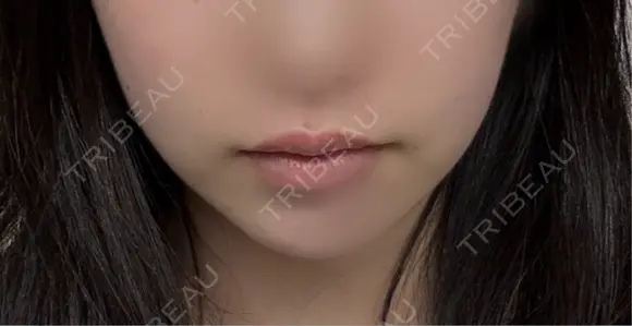 ボトックス（口角） TCB東京中央美容外科 京都駅前院 DAY 36 メイン用