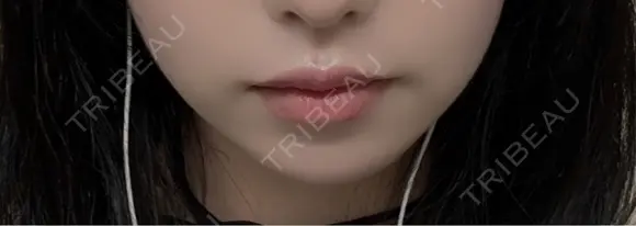 ボトックス（口角） TCB東京中央美容外科 京都駅前院 DAY 13 メイン用