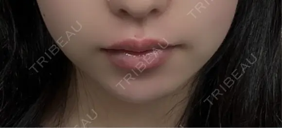 ボトックス（口角） TCB東京中央美容外科 京都駅前院 DAY 21 メイン用