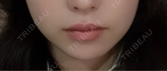 ボトックス（口角） TCB東京中央美容外科 京都駅前院 AFTER メイン用