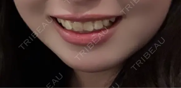 ボトックス（口角） TCB東京中央美容外科 京都駅前院 DAY 55 メイン用