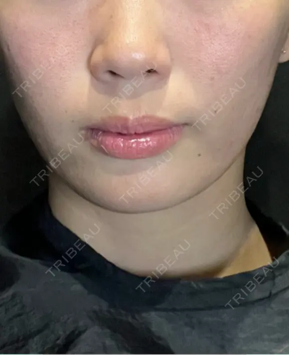 糸リフト / ボトックス（あご） / ヒアルロン酸注入（あご） / ヒアルロン酸注入（頬） Wing clinic 豊中駅前院 DAY 0 メイン用