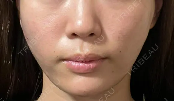 糸リフト / ボトックス（あご） / ヒアルロン酸注入（あご） / ヒアルロン酸注入（頬） Wing clinic 豊中駅前院 DAY 0 メイン用