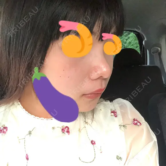 鼻尖形成（切開） / 小鼻縮小（切開） / 軟骨移植 / 眉間プロテーゼ 湘南美容クリニック 熊本院 DAY 34 メイン用