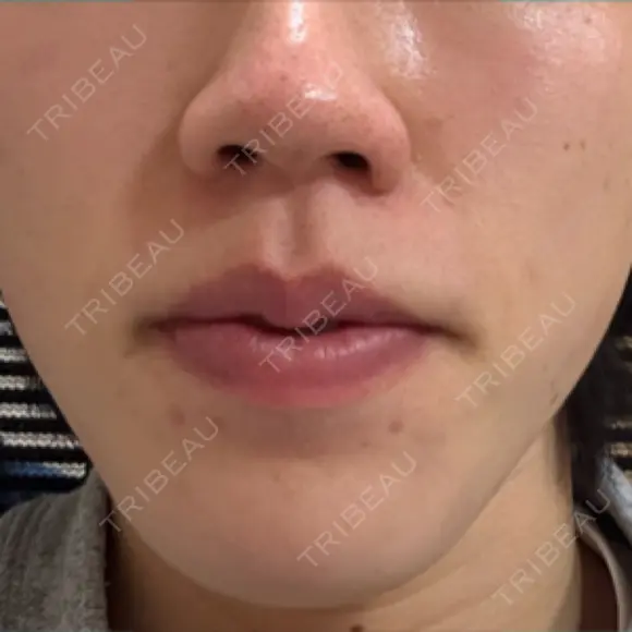 イオン導入 Kinshicho Beauty Clinic （錦糸町ビューティークリニック） AFTER メイン用