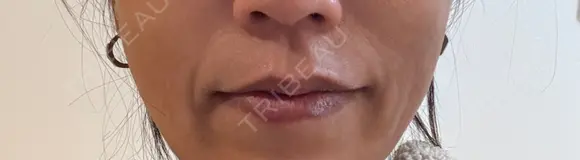 ヒアルロン酸注入（頬） Wi Clinic （ウィ クリニック）心斎橋院 DAY 0 メイン用
