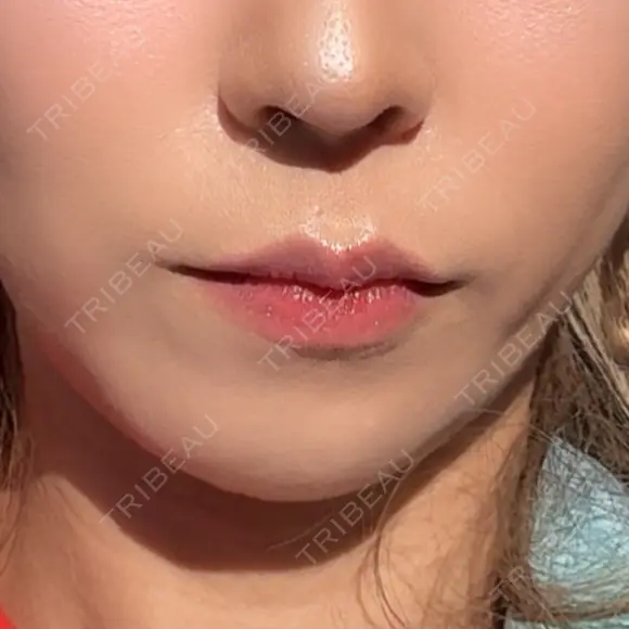 ボトックス（あご） / ボトックス（エラ・小顔） / ボトックス（口角） / ボトックス（人中） DMTC CLINIC 渋谷院 AFTER メイン用