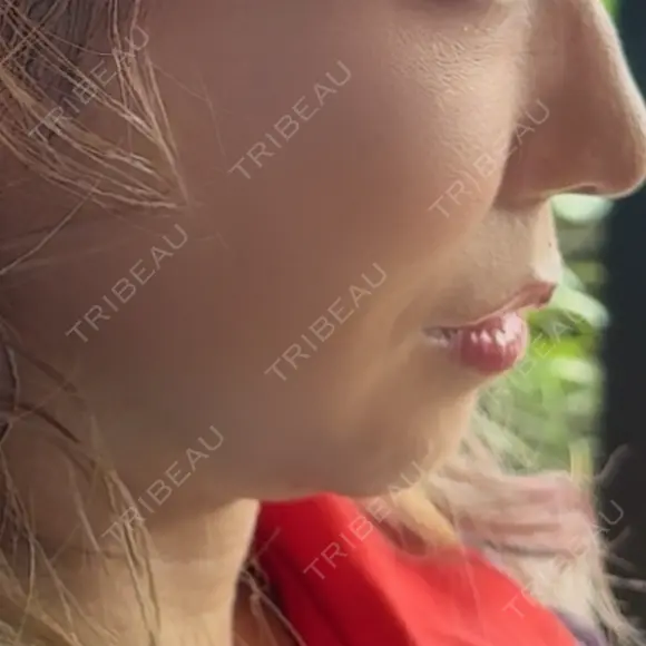 ボトックス（あご） / ボトックス（エラ・小顔） / ボトックス（口角） / ボトックス（人中） DMTC CLINIC 渋谷院 DAY 6 メイン用