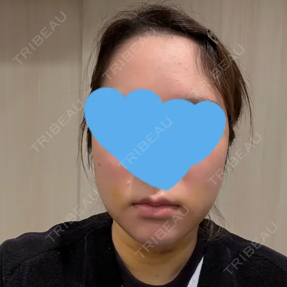 糸リフト / 脂肪吸引（顔） / ジョールファット除去 / 脂肪吸引注射（顔） SEA CLINIC（シークリニック） DAY 4 メイン用