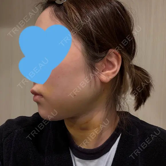 糸リフト / 脂肪吸引（顔） / ジョールファット除去 / 脂肪吸引注射（顔） SEA CLINIC（シークリニック） DAY 4 メイン用