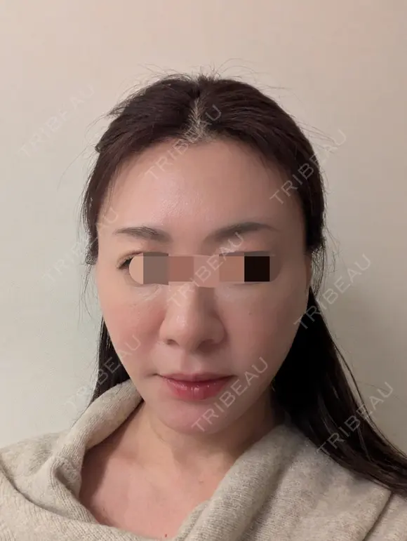 糸リフト / 脂肪吸引（顔） Wing clinic 豊中駅前院 DAY 4 メイン用