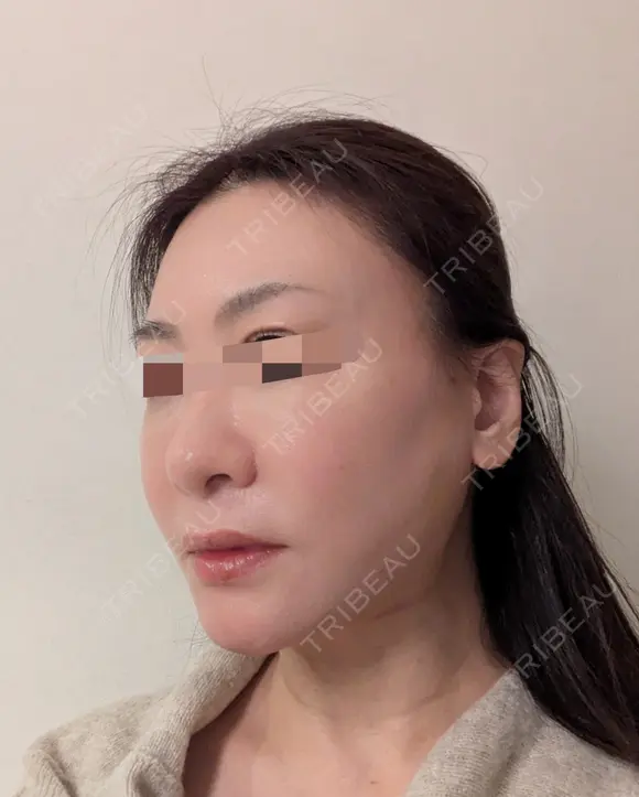 糸リフト / 脂肪吸引（顔） Wing clinic 豊中駅前院 DAY 4 メイン用