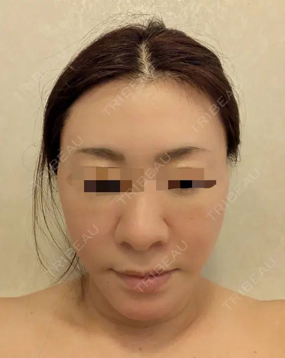 糸リフト / 脂肪吸引（顔） Wing clinic 豊中駅前院 DAY 6 メイン用