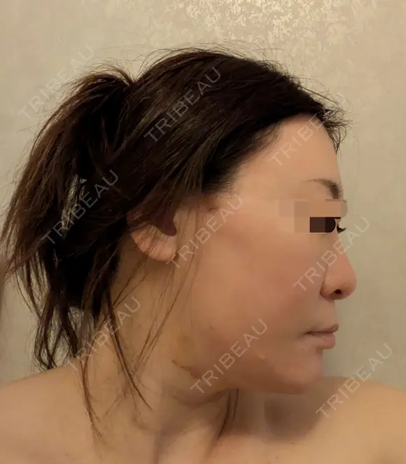 糸リフト / 脂肪吸引（顔） Wing clinic 豊中駅前院 DAY 6 メイン用