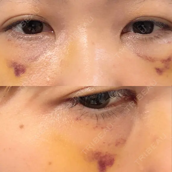 クマ治療 池袋麗歯科・美容皮膚科 DAY 12 メイン用