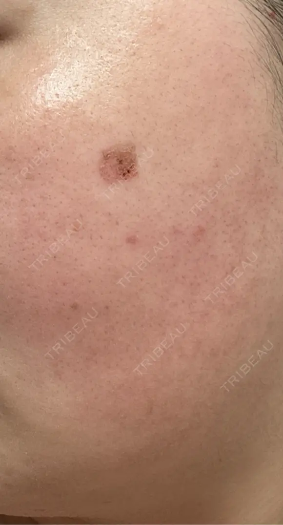 その他（肌） / シミ取りレーザー / ルメッカ ルラ美容クリニック 郡山院 DAY 12 メイン用