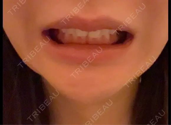 ボトックス（口角） BON BON CLINIC 渋谷院 DAY 1 メイン用