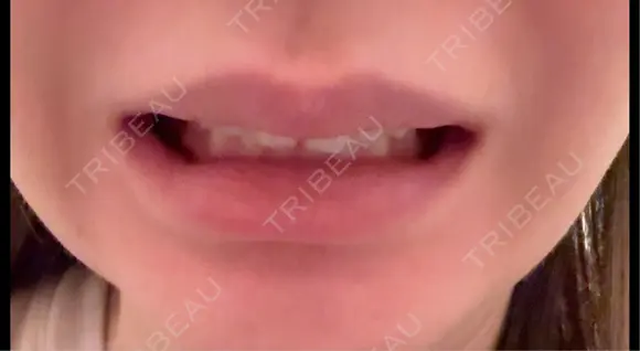 ボトックス（口角） BON BON CLINIC 渋谷院 DAY 2 メイン用