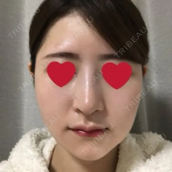 骨切り（あご） / 骨削り（エラ） / 骨削り（頬） / その他（輪郭） RG整形外科（旧リオン整形外科） DAY 12 メイン用