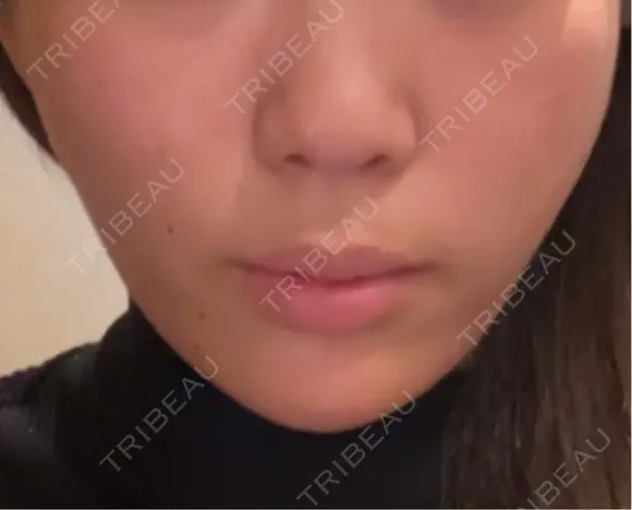 糸リフト / ボトックス（あご） / ヒアルロン酸注入（あご） / ヒアルロン酸注入（頬） Wing clinic 豊中駅前院 AFTER メイン用