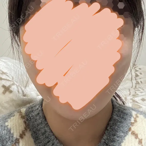 糸リフト / バッカルファット除去 / 脂肪吸引（顔） First Clinic AFTER メイン用