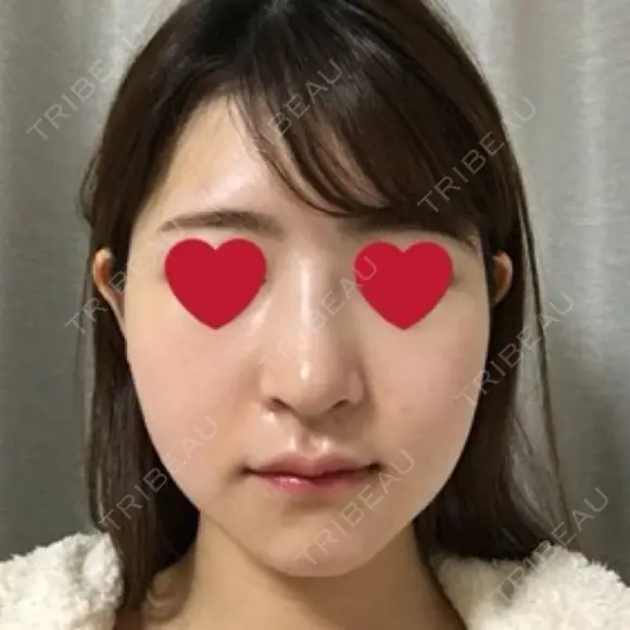 骨切り（あご） / 骨削り（エラ） / 骨削り（頬） / その他（輪郭） RG整形外科（旧リオン整形外科） DAY 15 メイン用