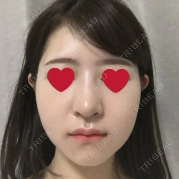 骨切り（あご） / 骨削り（エラ） / 骨削り（頬） / その他（輪郭） RG整形外科（旧リオン整形外科） DAY 20 メイン用