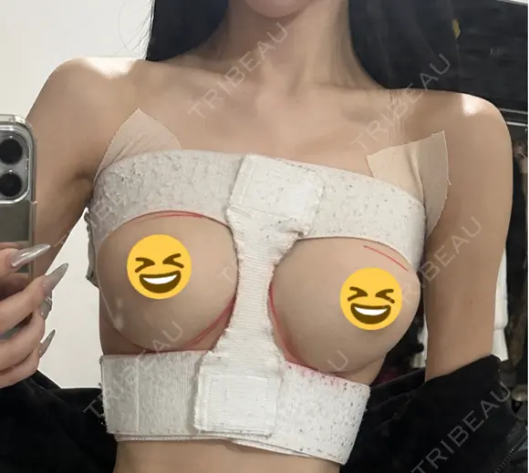 豊胸（シリコンバッグ） お茶の水美容形成クリニック DAY 1 メイン用