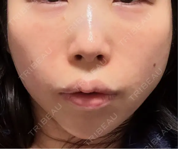 糸リフト 湘南美容クリニック 大阪京橋院 AFTER メイン用