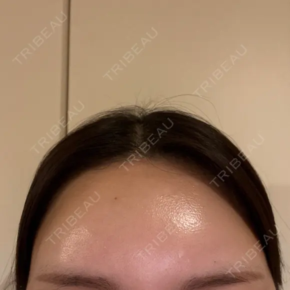 ヒアルロン酸注入（額） / ヒアルロン酸注入（こめかみ） Moon Beauty Clinic DAY 0 メイン用