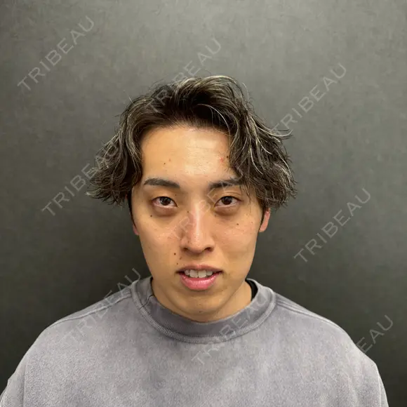 クマ治療 / ヒアルロン酸注入（目の下） / その他（目元） ネビュラクリニック 京都院 AFTER メイン用