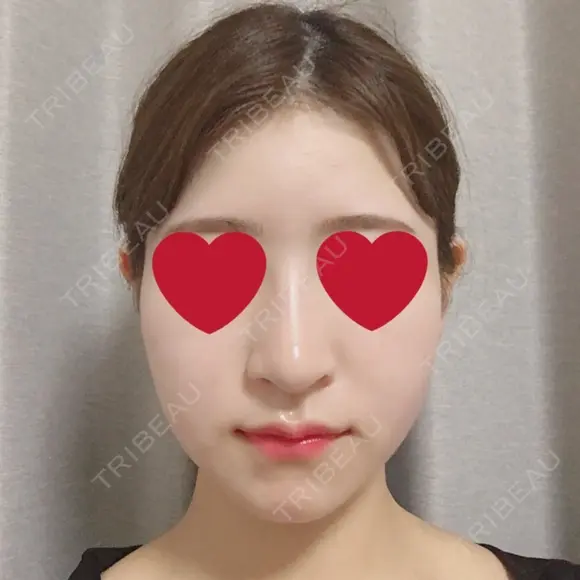 骨切り（あご） / 骨削り（エラ） / 骨削り（頬） / その他（輪郭） RG整形外科（旧リオン整形外科） DAY 43 メイン用