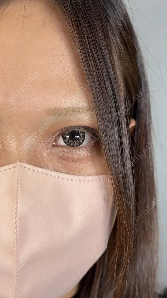二重切開 / 目頭切開 / 上まぶたたるみ取り アリエル美容クリニック 大宮院 DAY 42 メイン用