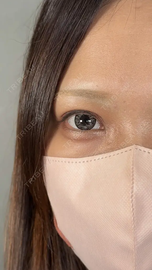 二重切開 / 目頭切開 / 上まぶたたるみ取り アリエル美容クリニック 大宮院 DAY 42 メイン用