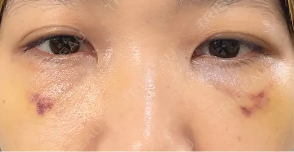 クマ治療 池袋麗歯科・美容皮膚科 DAY 14 メイン用